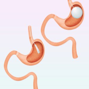 Bariatric Treatment Device